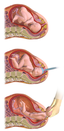 VENTOUSE OBSTETRICALE ELECTRIQUE 2X4L + 3 CUPULES