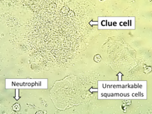 A vaginal wet mount with a clue cell, indicating bacterial vaginosis. Vaginal wet mount with clue cell - annotated.png