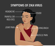 Sintomi del virus Zika