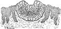 Figure 37. Section of a scutulum in situ, very thin layer of epidermis beneath, thin horny layer above. The fungus in the center is more closely packed, hence the depression. 100x