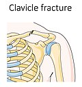Collarbone fracture - Clavicle fracture -- Smart-Servier.jpg