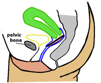 O disco menstrual colócase inmediatamente debaixo do cérvix e mantense nesa posición pola presión do óso púbico.