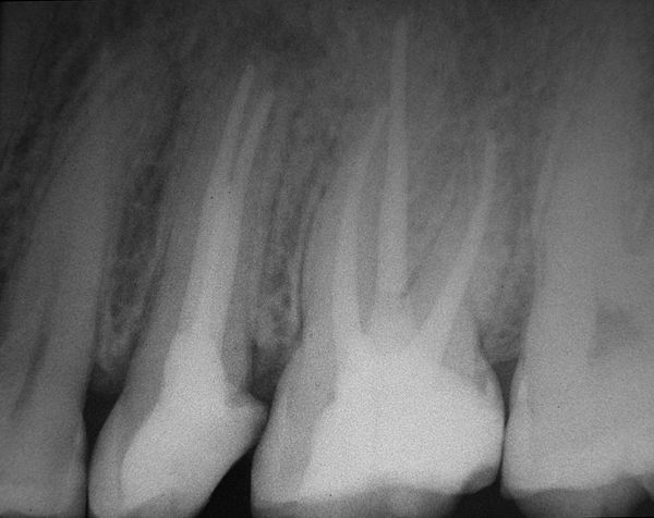 Снимки каналов. Зуб 26 прицельный снимок. Рентген запломбированных каналов зуба. Запломбированные каналы на рентгене. Пломбировка каналов 26 зуба.