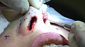 Exposing lower lateral cartilage during rhinoplasty