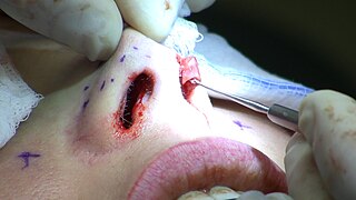 <span class="mw-page-title-main">Rhinoplasty</span> Surgical procedure to enhance or reconstruct a human nose