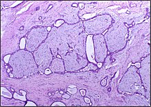 Histopathologic image of breast fibroadenoma showing proliferation of intralobular stroma compressing and distorting the epithelium. H&E stain.