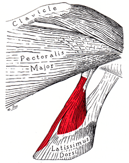 Axillary arch Muscular slip associated with latissimus dorsi muslce.