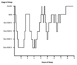 Example hypnogram for a normal, healthy adult. Within the first hour of sleep SWS is diplayed. Cycles of REM and NREM sleep proceed. During the third cycle of sleep there are 2 breif wake states. During the second half of the sleep period more REM sleep is displayed and there is litle SWS is detected