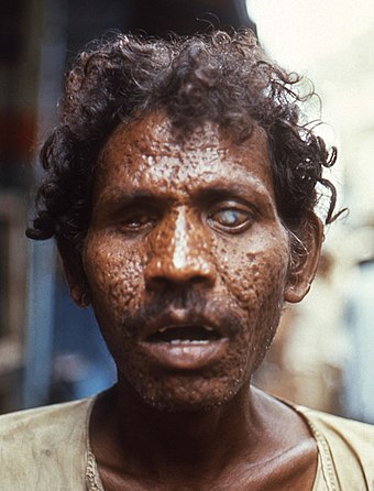 Smallpox survivor with facial scarring, blindness and white corneal scar in his left eye, 1972