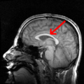 Mri brain side view-emphasizing-corpus-callosum.png