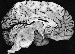 Fibrillary astrocytoma