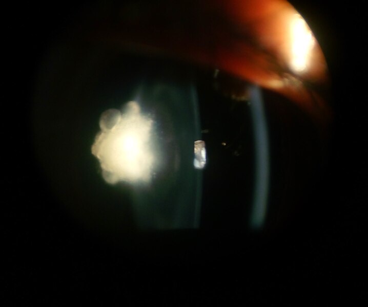 File:Posterior polar cataract.jpg