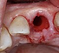 Situation nach Bohrung des Implantatbettes in der Extraktionsalveole.