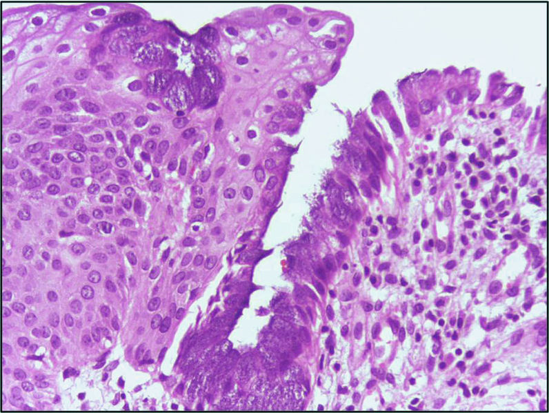 File:Squamous metaplasia.jpg