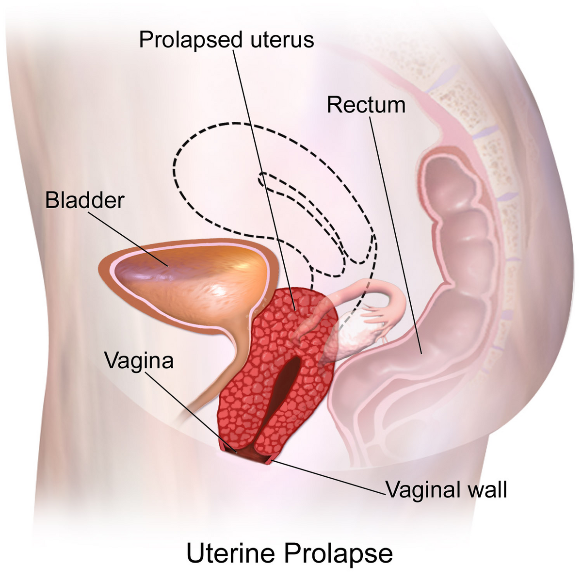 JAMA on X: Uterine prolapse occurs when the uterus drops into the vagina.  This JAMA Patient Page discusses diagnosis and treatment options for uterine  prolapse.   / X