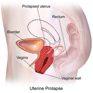 Illustration of uterine prolapse in which the uterus protrudes into the vaginal canal