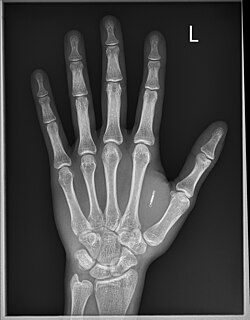 X-Ray of RFID Implant.jpg