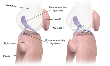 Diagram of the ACL; and a torn ACL. ACL Tear.png