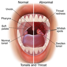 A set of large tonsils in the back of the throat covered in yellow exudate