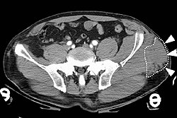 A Morel-Lavallée lesion involving the left pelvis as seen on تصوير مقطعي محوسب.