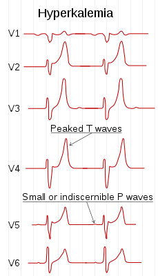 Электрокардиограмма, которая показывает изменения в Грудных отводах при гиперкалиемии.