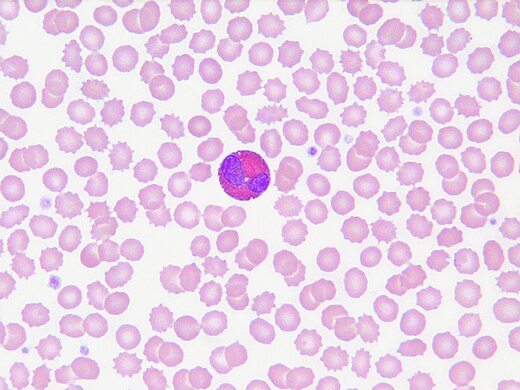 Eosinophils in peripheral blood.jpg