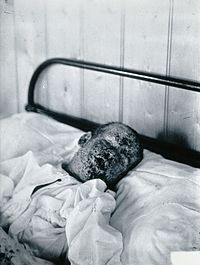 Gloucester smallpox epidemic, 1896; Henry Wicklin, aged 6 Wellcome V0031456.jpg