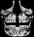 Unerupted permanent teeth underlie the deciduous teeth.