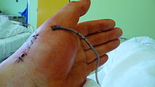 Surgical drain on the left hand after surgery of Bennett's fracture basis MTC primi manus 1. sin (S62.20) which was treated by alignment of a fracture and inside fixation by two titanium screws MS. Hand with drain after surgery (2).jpg