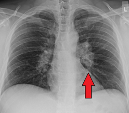 Sarcoidosis