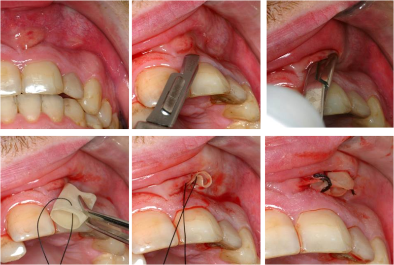 File:Incision and drainage mouth.png
