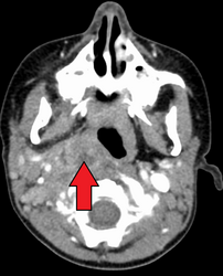 Large retropharyngeal abscess as seen on CT