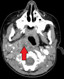 peritonsillar abscess x ray