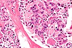 Thumbnail for Multiple endocrine neoplasia type 2B