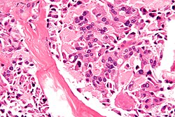 صورة مجهرية لسرطان درقي نخاعي، كما يرى في تكون الورم الصماوي المتعدد النوع 2 ب، بصبغة الهيماتوكسيلين والأيوزين.