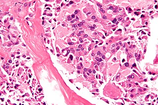 <span class="mw-page-title-main">Multiple endocrine neoplasia type 2B</span> Medical condition