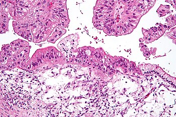 Micrograph of a mucinous ovarian tumor. H&E stain. Mucinous lmp ovarian tumour intermed mag.jpg