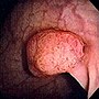 Thumbnail for Colorectal polyp