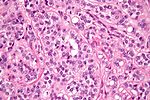 Thumbnail for Sertoli cell tumour