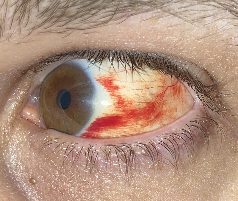 File:Human eye with blood vessels.jpg - Wikipedia