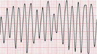 Flutter ventricolare: caratterizzato da onde ampie e sinusoidali con frequenze che oscillano fra i 150 e i 300 batt/min. Tale aritmia necessita di defibrillazione, poiché determina in tempi rapidi una sincope con collasso emodinamico.[54]