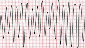 ventricular flutter vs fibrillation