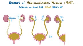 Dosiero: Vesikoureteral reflux.ŭebm