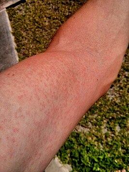 Zika.Virus.Rash.Arm.2014.jpg