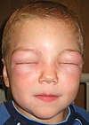 Angioedema pada wajah hingga anak laki-laki ini tidak dapat membuka matanya. Reaksi ini disebabkan oleh paparan alergen.