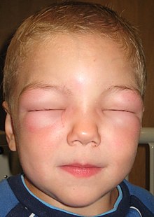 אנגיואדמה אלרגית: ילד אינו מסוגל לפתוח את עיניו כתוצאה מהנפיחות החמורה בעיניו.