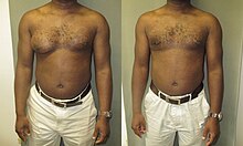 Asymmetrical gynecomastia.jpg