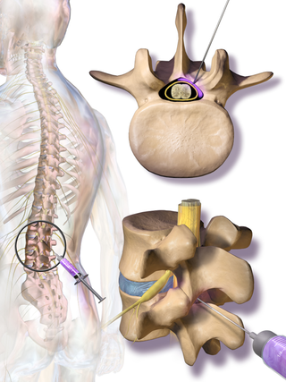 <span class="mw-page-title-main">Epidural steroid injection</span> Medical treatment