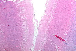 Micrograph showing cortical pseudolaminar necrosis. H&E-LFB stain. Cortical pseudolaminar necrosis - lfb - very low mag.jpg