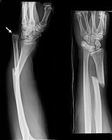 Galeazzi fracture